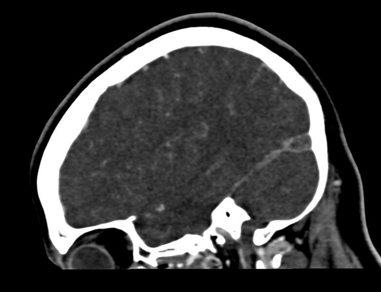 File:Cerebral venous sinus thrombosis (Radiopaedia 59224-66646 Sagittal C+ delayed 48).jpg