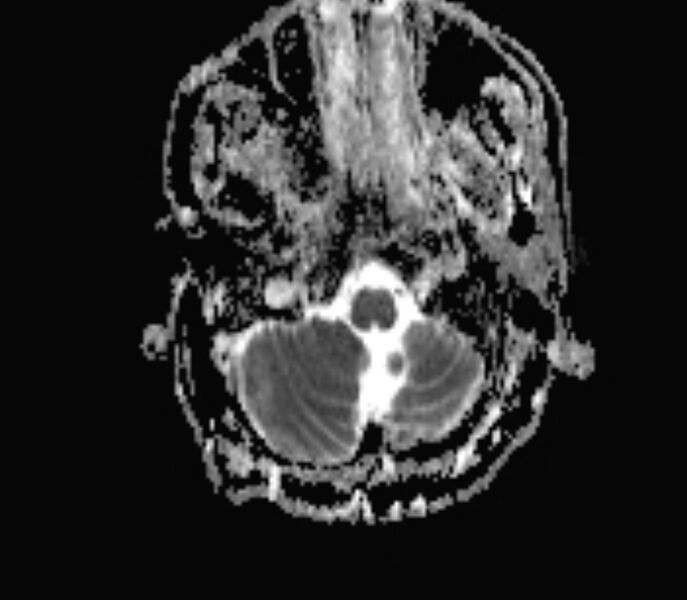 File:Cerebral venous thrombosis (Radiopaedia 71207-81504 Axial ADC 2).jpg