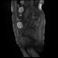 Cervical carcinoma (Radiopaedia 78847-91705 Sagittal T1 fat sat 14).jpg