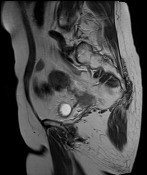 File:Cervical carcinoma (Radiopaedia 88312-104943 Sagittal T2 20).jpg