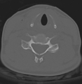 Cervical disc replacement (Radiopaedia 37383-39205 Axial bone window 6).png