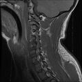 Cervical flexion teardrop fracture with cord hemorrhage (Radiopaedia 32497-33455 Sagittal T1 5).jpg