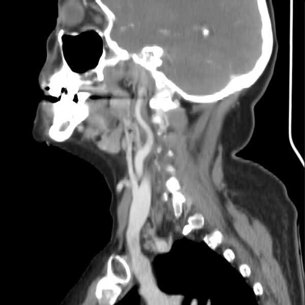 File:Cervical lymphadenopathy- cause unknown (Radiopaedia 22420-22457 D 13).jpg