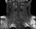 Cervical schwannoma (Radiopaedia 72399-82934 G 10).jpg