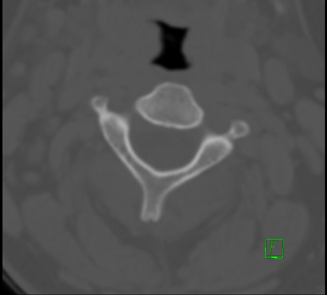 File:Cervical spine fracture - hyperflexion injury (Radiopaedia 66184-75364 Axial bone window 9).jpg