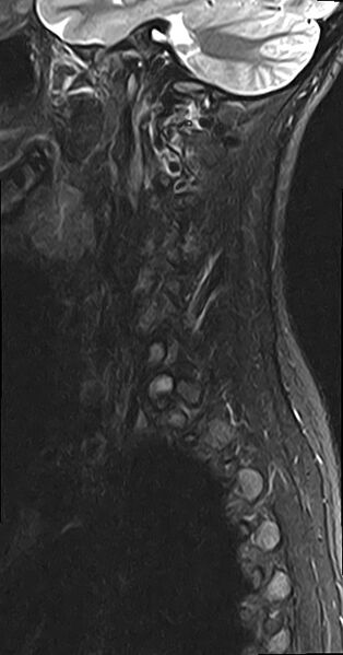 File:Cervical spondylodiscitis and calvarial hemangioma (Radiopaedia 64317-73104 Sagittal STIR 1).jpg