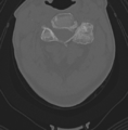 Cervical spondylolysis (Radiopaedia 49616-54811 Axial bone window 25).png