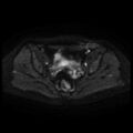 Cesarian section scar endometriosis (Radiopaedia 66520-75799 Axial DWI 38).jpg