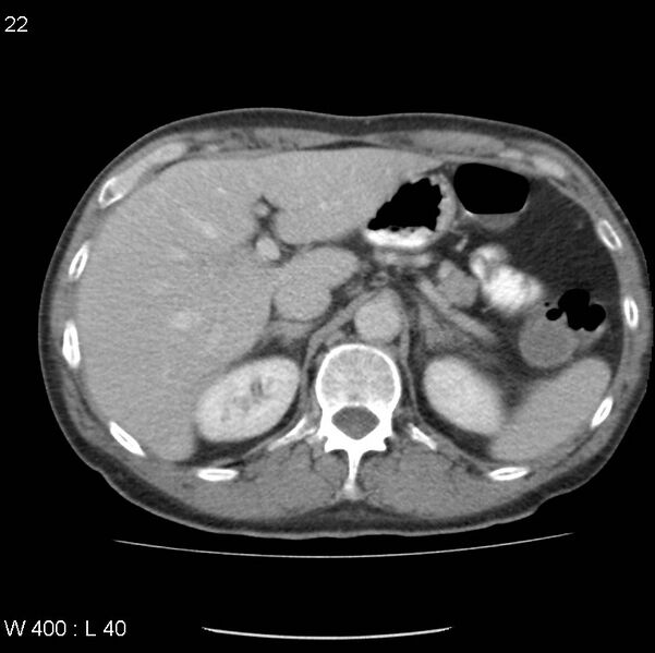 File:Chemotherapy induced enteritis (Radiopaedia 18594-18492 B 15).jpg