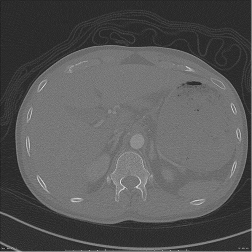 Chest and abdomen multi-trauma (Radiopaedia 26294-26425 bone window 103).jpg