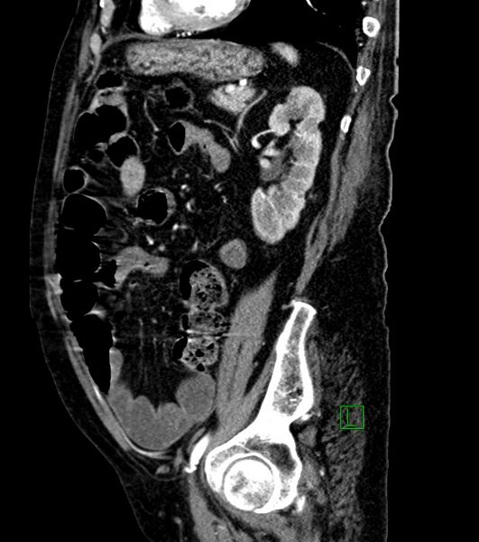 File:Cholangiocarcinoma with cerebral metastases (Radiopaedia 83519-98629 F 42).jpg