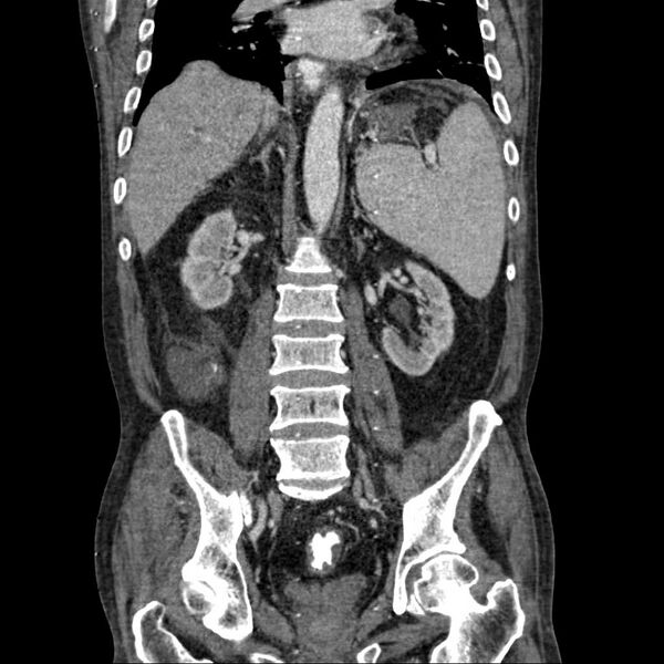 File:Cholangitis and abscess formation in a patient with cholangiocarcinoma (Radiopaedia 21194-21100 C 13).jpg