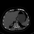 Cholecystitis - CT IVC obstructive choledocholitiasis (Radiopaedia 43966-47479 C 23).png