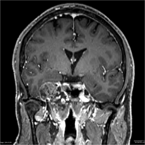 File:Chondrosarcoma of skull base- grade II (Radiopaedia 40948-43654 Coronal T1 C+ 15).jpg