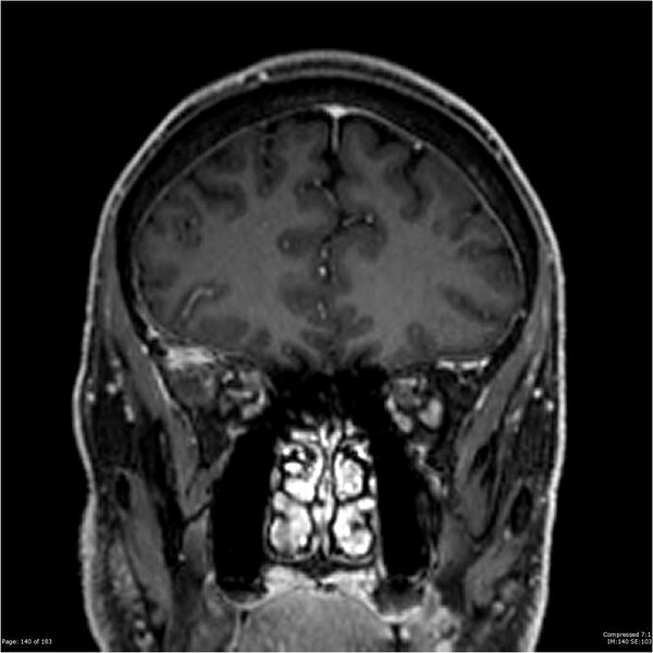 File:Chondrosarcoma of skull base- grade II (Radiopaedia 40948-43654 Coronal T1 C+ 51).jpg
