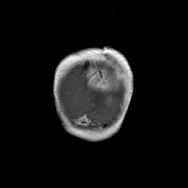 File:Choroid plexus carcinoma (Radiopaedia 21121-21035 Coronal T1 C+ 1).jpg