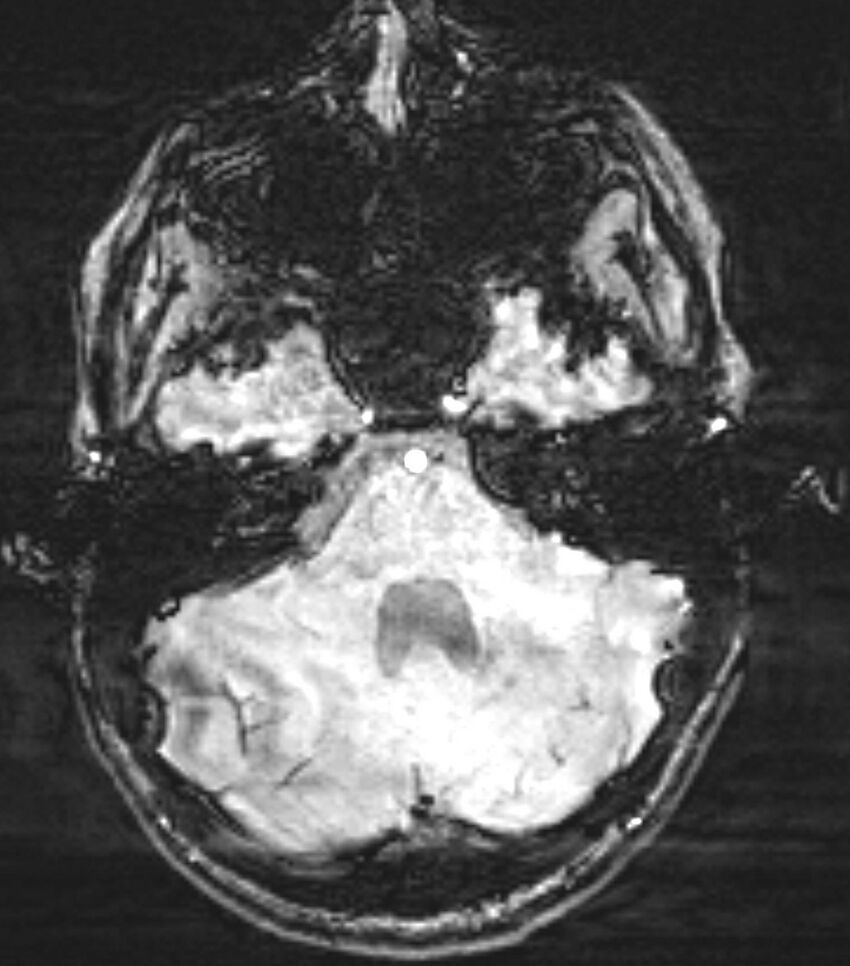 Choroid plexus carcinoma (Radiopaedia 91013-108553 Axial SWI 24).jpg