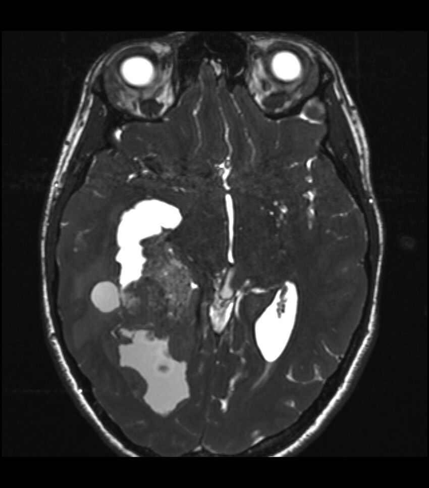 Choroid plexus carcinoma (Radiopaedia 91013-108553 Axial T2 CISS 29).jpg