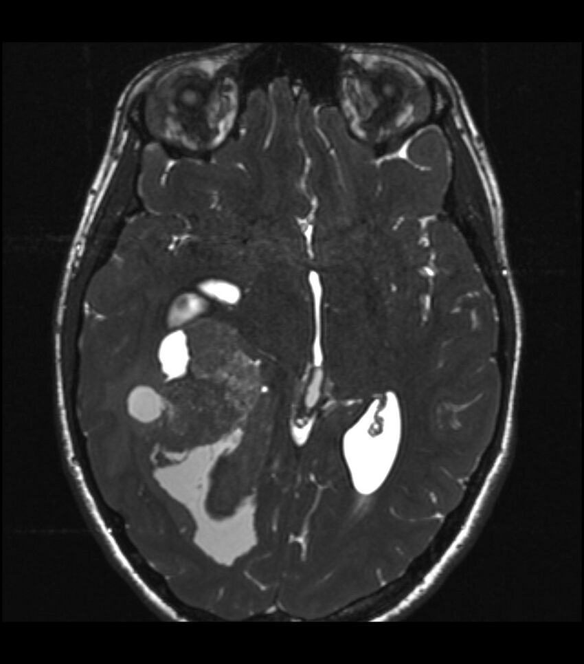 Choroid plexus carcinoma (Radiopaedia 91013-108553 Axial T2 CISS 32).jpg
