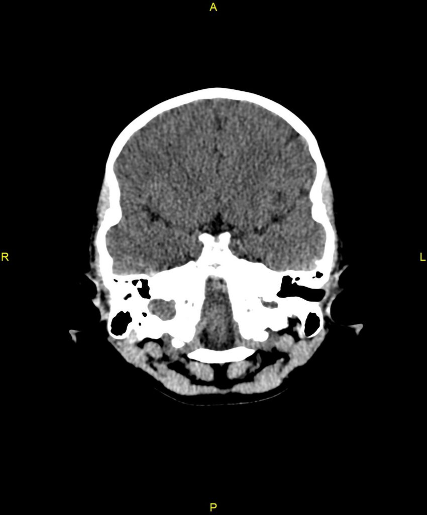 Choroidal fissure cyst (Radiopaedia 89481-106465 Axial non-contrast 36).jpg