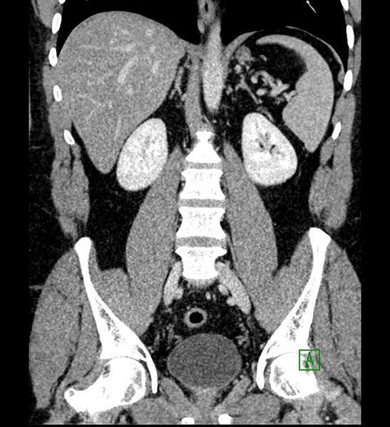 File:Chromophobe renal cell carcinoma (Radiopaedia 84286-99573 H 111).jpg