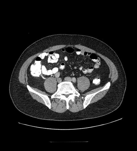 File:Chromophobe renal cell carcinoma (Radiopaedia 84337-99644 C 90).jpg