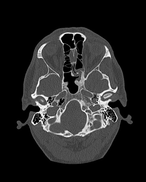 File:Chronic maxillary sinusitis caused by a foreign body (Radiopaedia 58521-65676 Axial bone window 218).jpg
