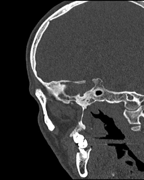 File:Chronic maxillary sinusitis caused by a foreign body (Radiopaedia 58521-65676 Sagittal bone window 64).jpg