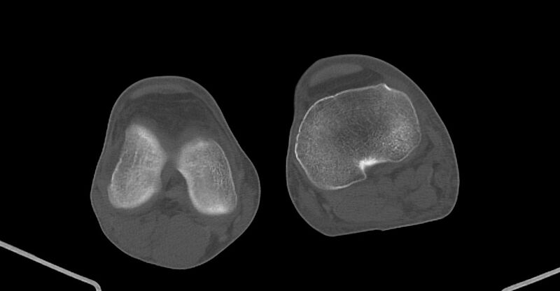 File:Chronic osteomyelitis (with sequestrum) (Radiopaedia 74813-85822 Axial non-contrast 193).jpg
