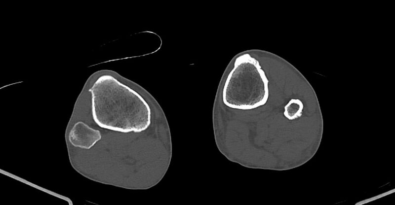 File:Chronic osteomyelitis (with sequestrum) (Radiopaedia 74813-85822 Axial non-contrast 209).jpg