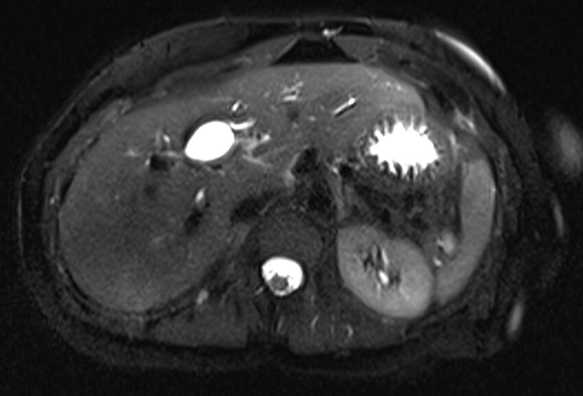 Chronic pancreatitis - pancreatic duct calculi (Radiopaedia 71818-82250 Axial T2 fat sat 19).jpg