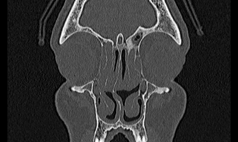 File:Chronic rhinosinusitis (Radiopaedia 65079-74075 Coronal bone window 18).jpg