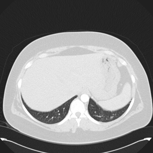 File:Chronic thromboembolic pulmonary hypertension (CTEPH) (Radiopaedia 74597-85531 Axial lung window 46).jpg