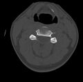 Clay-shoveler fracture (Radiopaedia 22568-22590 Axial bone window 32).jpg