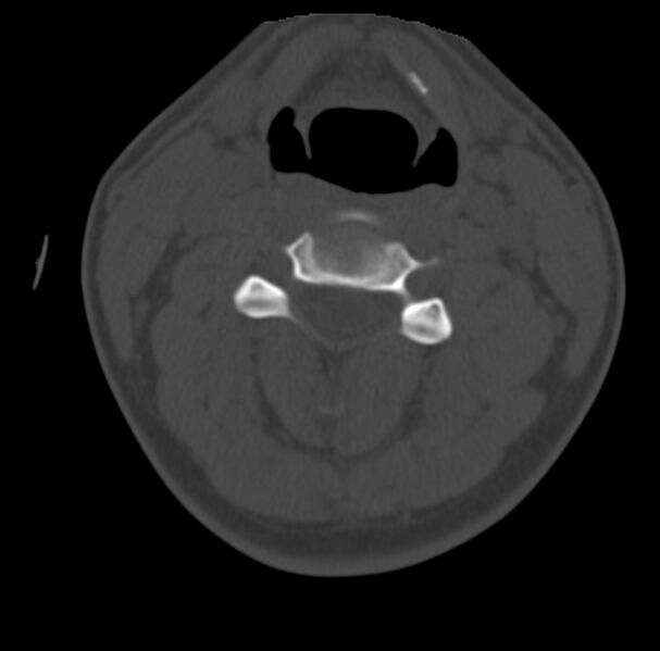 File:Clay-shoveler fracture (Radiopaedia 22568-22590 Axial bone window 32).jpg