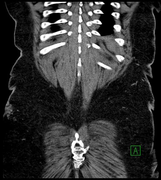 File:Closed-loop small bowel obstruction-internal hernia (Radiopaedia 78439-91096 Coronal non-contrast 90).jpg