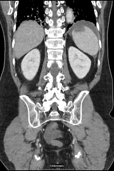 File:Closed loop bowel obstruction and ischemia (Radiopaedia 86959-103180 B 35).jpg