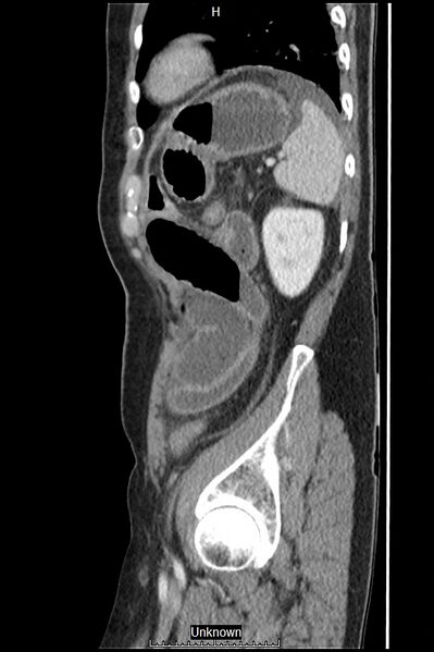 File:Closed loop bowel obstruction and ischemia (Radiopaedia 86959-103180 C 10).jpg