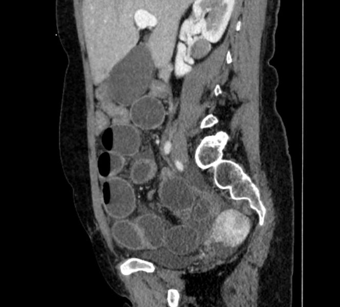 File:Closed loop small bowel obstruction (Radiopaedia 71211-81508 C 49).jpg