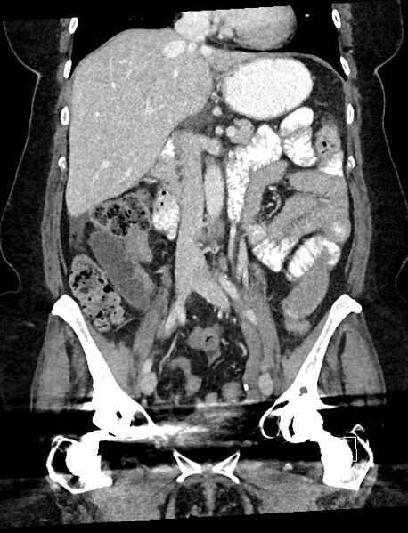 File:Closed loop small bowel obstruction - adhesions (Radiopaedia 59078-66369 B 60).jpg