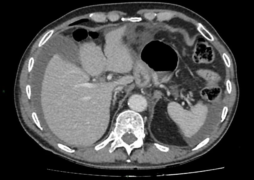Closed loop small bowel obstruction with ischemia (Radiopaedia 84180-99456 A 23).jpg