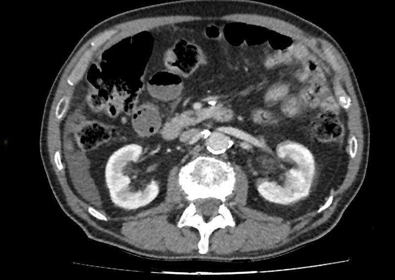 File:Closed loop small bowel obstruction with ischemia (Radiopaedia 84180-99456 A 48).jpg