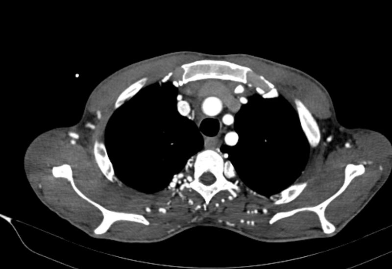 File:Coarctation of aorta with aortic valve stenosis (Radiopaedia 70463-80574 A 13).jpg