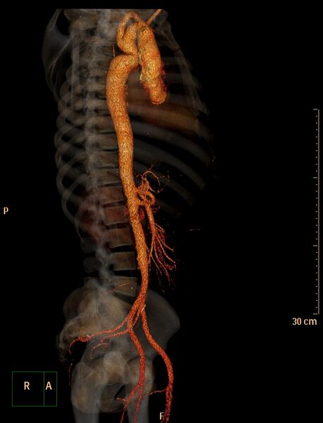 File:Coarctation of the aorta (Radiopaedia 49784-55050 3D VRT 6).jpg