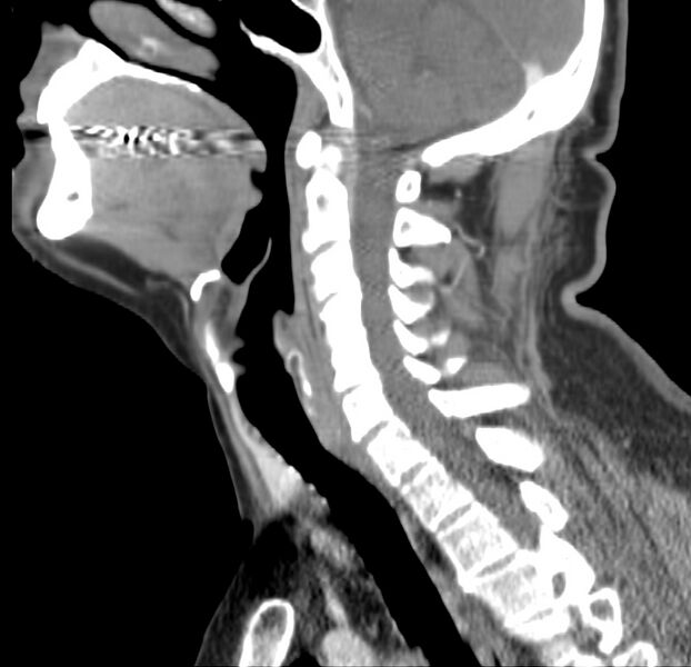 File:Colloid cyst of thyroid (Radiopaedia 22897-22923 Sagittal C+ delayed 29).jpg