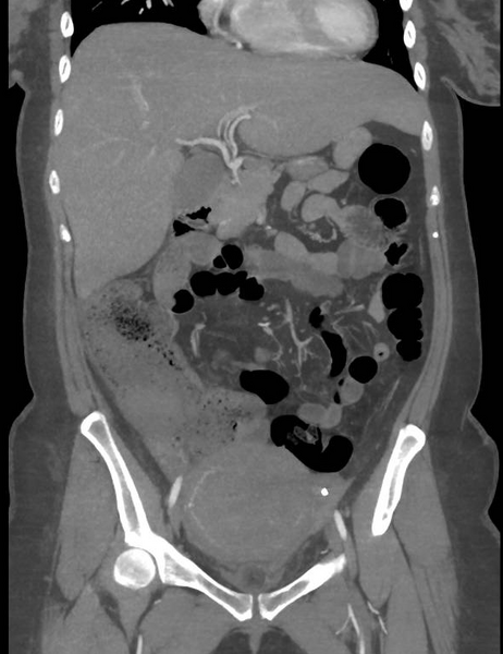 File:Colonic pseudo-obstruction (Radiopaedia 79752-92980 B 29).png