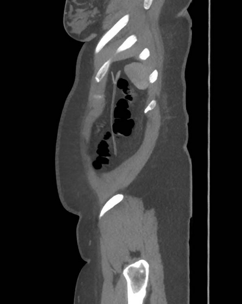 File:Colonic pseudo-obstruction (Radiopaedia 79752-92980 C 67).png