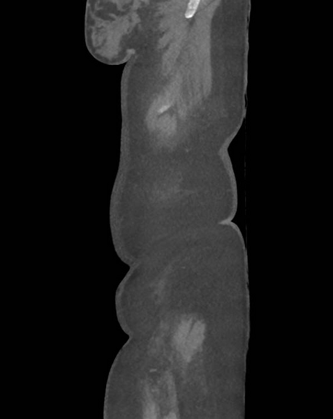 File:Colonic pseudo-obstruction (Radiopaedia 79752-92980 C 7).png
