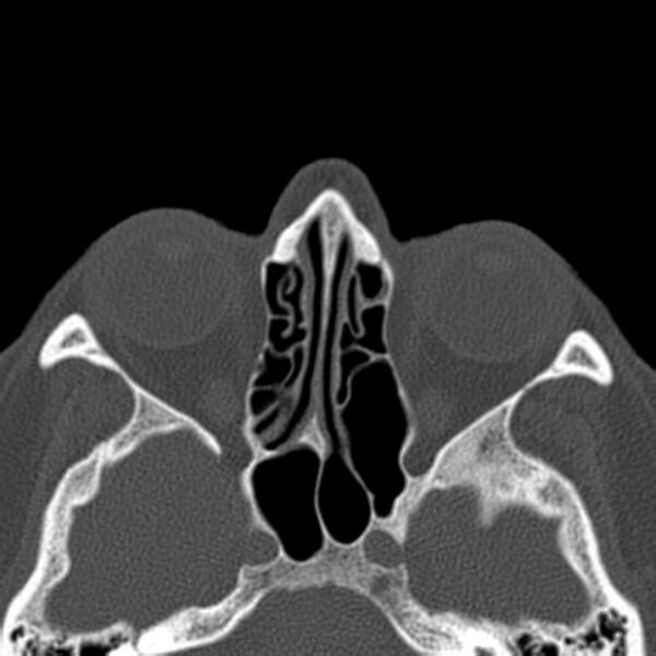 File:Nasolabial cyst (Radiopaedia 33987-35205 Axial bone window 29).jpg