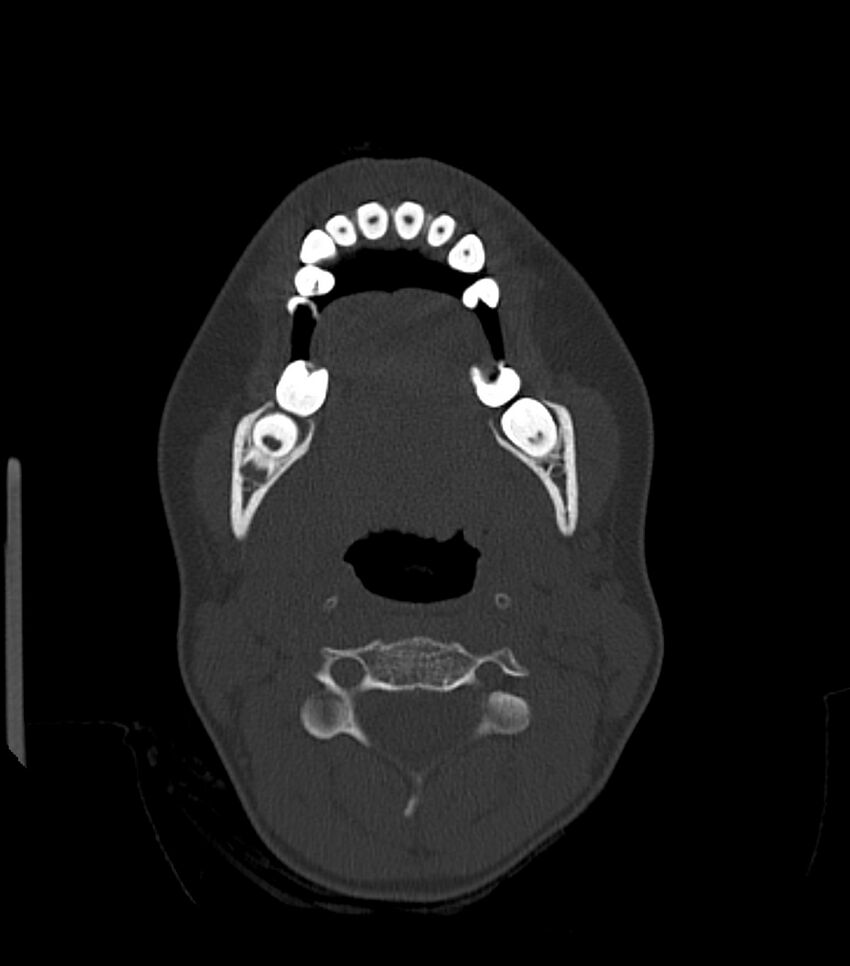 Nasoorbitoethmoid fracture (Radiopaedia 90044-107205 Axial bone window 37).jpg